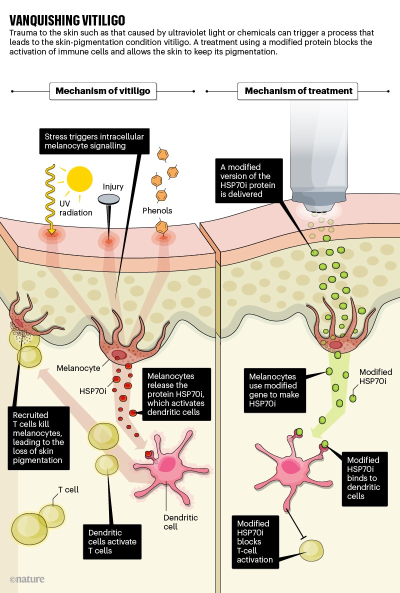 glutathione treatment for vitiligo Advances in Focus on Immunomodulatory Pathways, Cellular Grafting, and Emerging Drug Targets Temprian Therapeutics: developing a gene-based