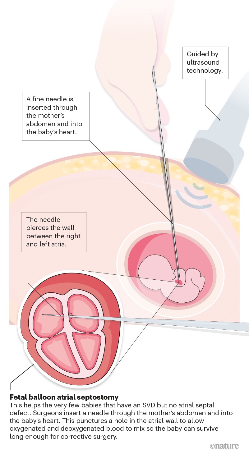 How to repair a baby's broken heart