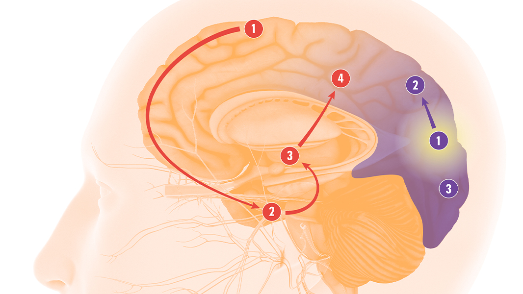 A Visual Guide To Migraine Headaches
