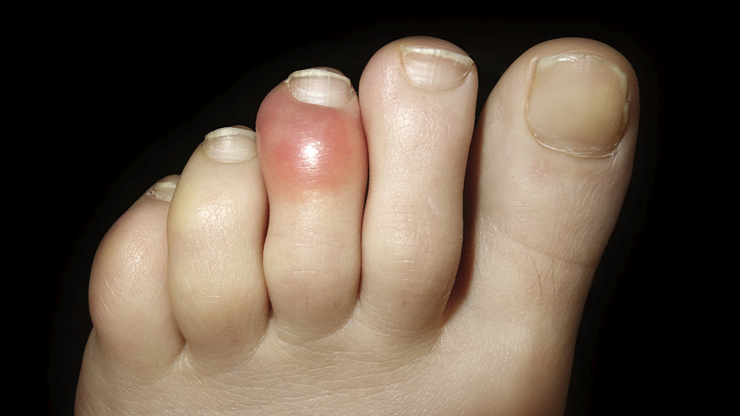 Red Toes Symptoms