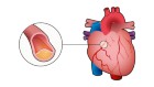A graphical guide to ischaemic heart disease