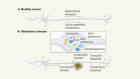 Swollen axons impair neuronal circuits in Alzheimer’s disease