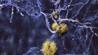 FDA approves Alzheimer’s drug lecanemab amid safety concerns