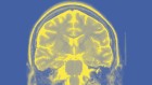 大脑虚拟模型将如何改变癫痫手术