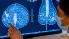 巨大的飞跃在乳腺癌生存率