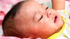 Measles outbreaks cause alarm: what the data say