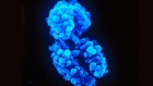 Why autoimmune disease is more common in women: X chromosome holds clues