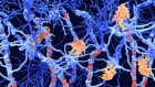 CAR T therapy for multiple sclerosis enters US trials for first time