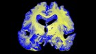 A test for Alzheimer’s-disease stage predicts dementia risk