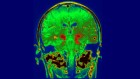 Diabetes drug slows development of Parkinson’s disease