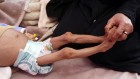 Famine exposure in the womb doubles diabetes risk decades later