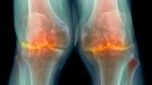 Anti-obesity drug has life-changing benefits for arthritis