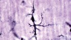 Alzheimer’s disease: highlights from research