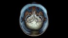 Storm of seizures in a baby’s brain calms after trial therapy