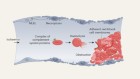 Sticky membranes of dead red blood cells obstruct small vessels