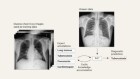 An open AI model could help medical experts to interpret chest X-rays