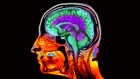 How fast is your brain ageing? Ordinary scans reveal the pace