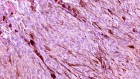 Workouts can help gut microbes to quell cancer