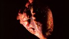 Heart from organ donor restarted outside the body — technique offers new source of organs