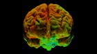 The optimistic brain: scans reveal thought patterns shared by positive thinkers