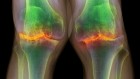 Ageing stem cells in the knees drive arthritis damage