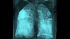 ‘Sleeping’ cancer cells in the lungs can be roused by COVID and flu