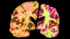 New hope for Alzheimer’s: lithium supplement reverses memory loss in mice