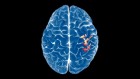 The brain’s map of the body is surprisingly stable — even after a limb is lost